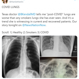 新型コロナウイルス感染後の肺と喫煙者の肺を比較したレントゲン写真 「自分の目で見ないと事態がどれだけ深刻か理解できない人が多すぎる」「いまだに“ただの風邪でしょ”って言ってる人いるもんな」