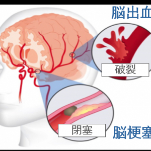 日本発・脳梗塞治療薬候補「TMS-007」、治療可能時間を5倍に広げる挑戦